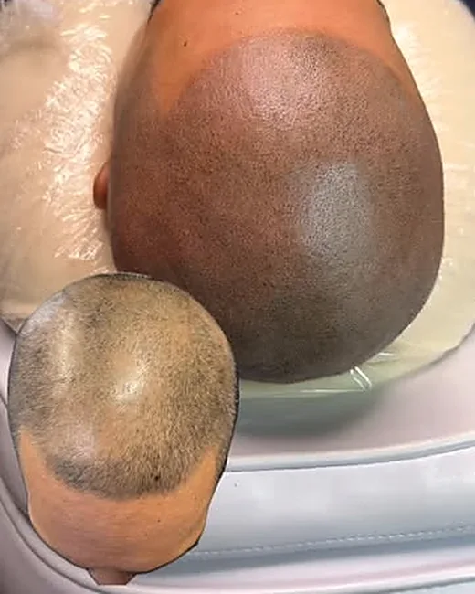 Scalp micropigmentation by Ryno Aggenbach — front hairline, with the before