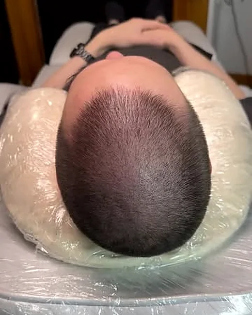 Scalp micropigmentation by Ryno Aggenbach — crown and mid-scalp density
