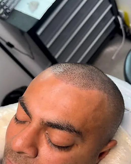 Scalp micropigmentation by Ryno Aggenbach — healed hairline, side view