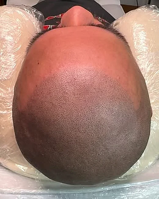 Scalp micropigmentation by Ryno Aggenbach — crown density, top down