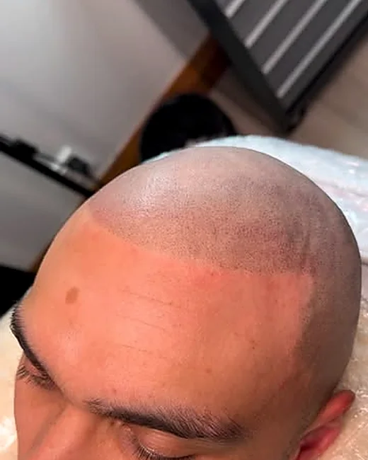 Scalp micropigmentation by Ryno Aggenbach — full scalp, side view