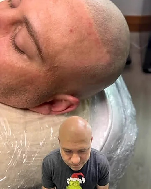 Scalp micropigmentation by Ryno Aggenbach — hairline side profile, with the before