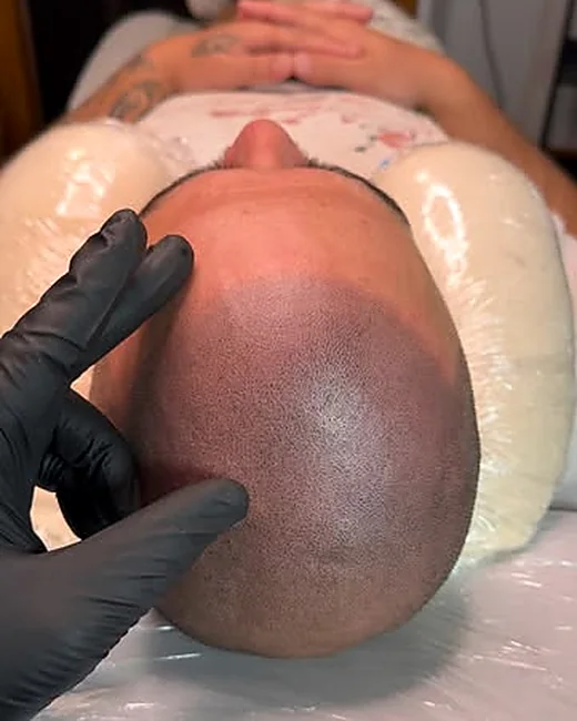 Scalp micropigmentation by Ryno Aggenbach — density work in progress