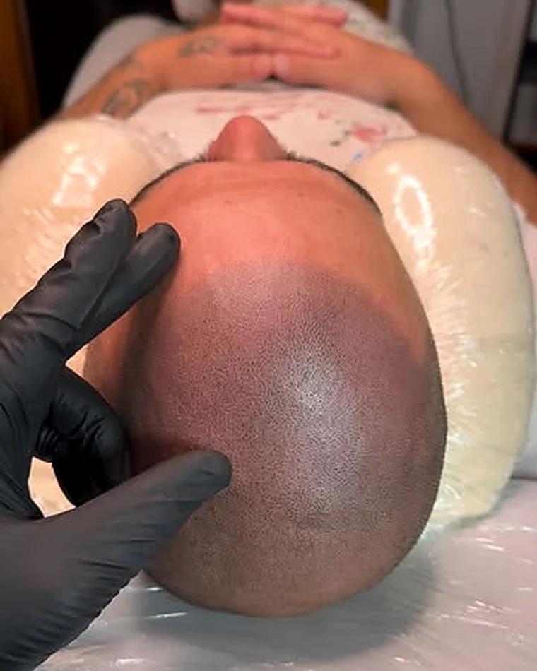 Scalp micropigmentation session in progress at SMP by Ryno, Wellington